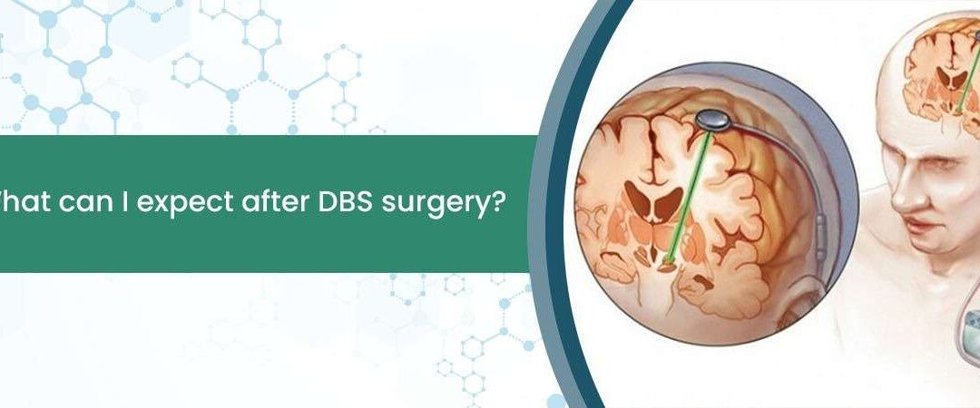 What can I expect after DBS surgery?