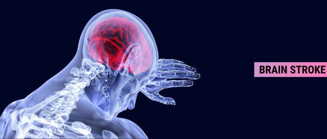 Brain Stroke: Time & Awareness Are The Key To Saving A Life