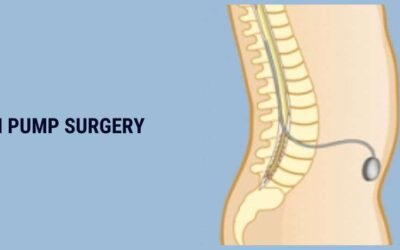 All You Need To Know About Baclofen Pump Surgery