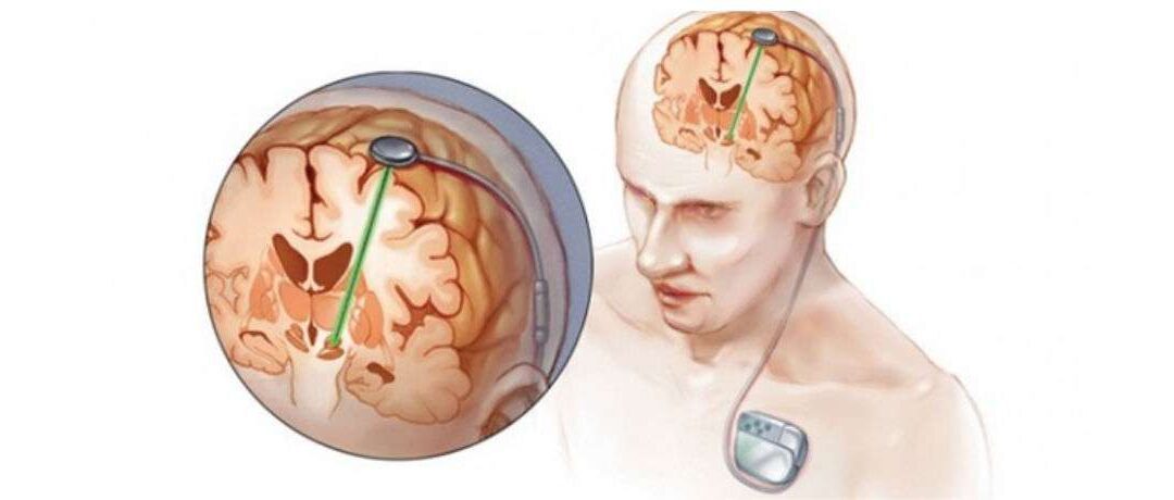 Deep Brain Stimulation