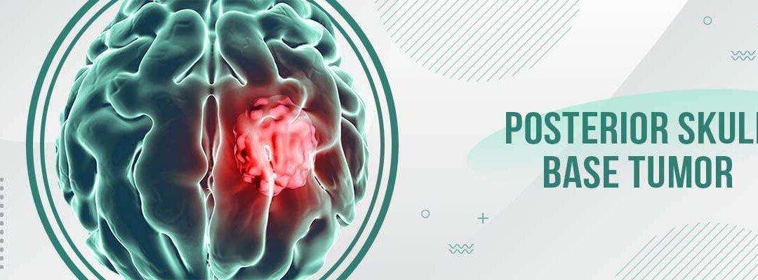 Posterior Skull Base Tumor