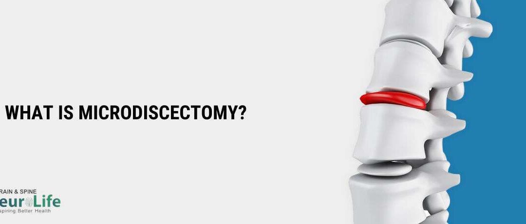 Microdiscectomy – How It Can Help Relieve Sciatica?