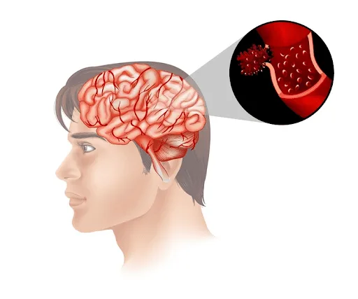 Bleeding Or Blood Clot | Gurneet Bleeding Or Blood Clot