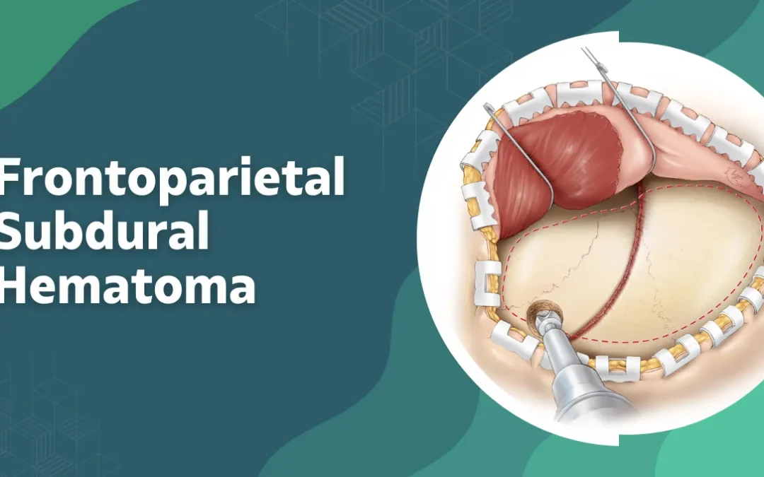 Frontoparietal Subdural Hematoma