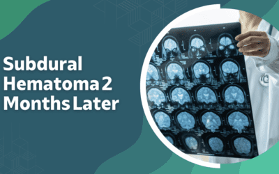 Understanding Subdural Hematoma 2 Months Later