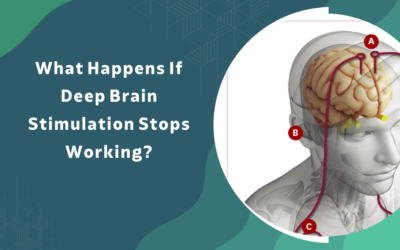 What Happens If Deep Brain Stimulation Stops Working