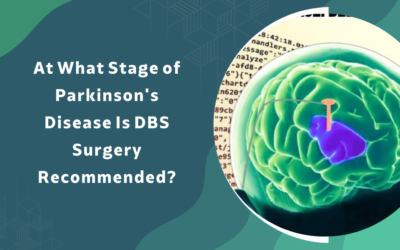 What Stage of Parkinson’s Is DBS Surgery Recommended