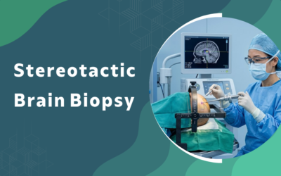 What is stereotactic brain biopsy and when is it required?