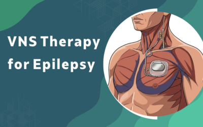 What is VNS Therapy for Epilepsy and Who is it For?