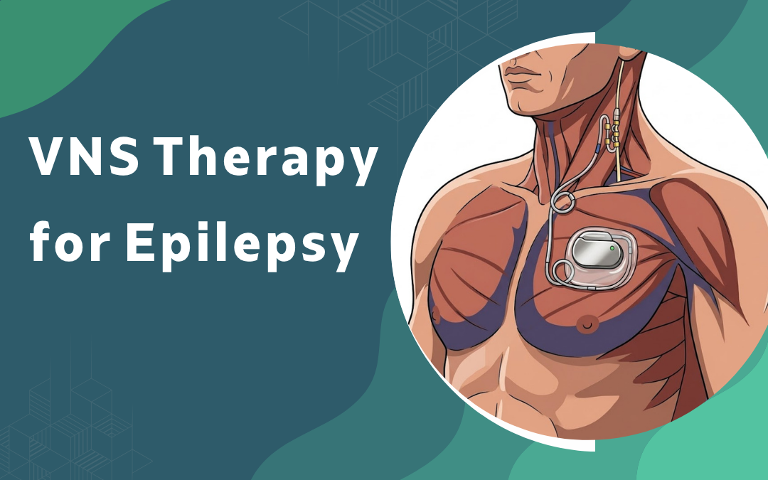 VNS Therapy for Epilepsy