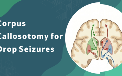 What is corpus callosotomy and how does it stop drop seizures?