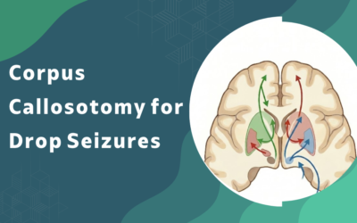 What is corpus callosotomy and how does it stop drop seizures?