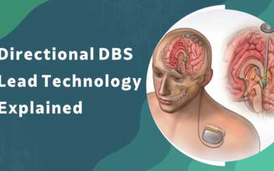 What Is Directional DBS Lead Technology and How Is It Different From Conventional Leads?