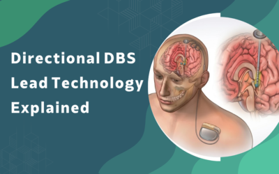 What Is Directional DBS Lead Technology and How Is It Different From Conventional Leads?