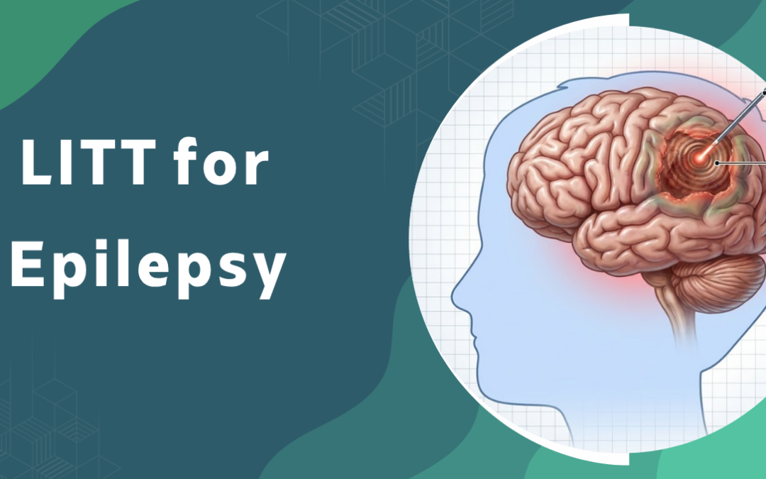 LITT for Epilepsy
