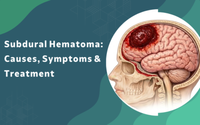 What are the causes, symptoms, and treatment options for subdural hematoma?