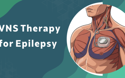 What is VNS Therapy for Epilepsy and Who is it For?