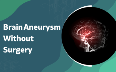 Can a Brain Aneurysm Be Treated Without Surgery?