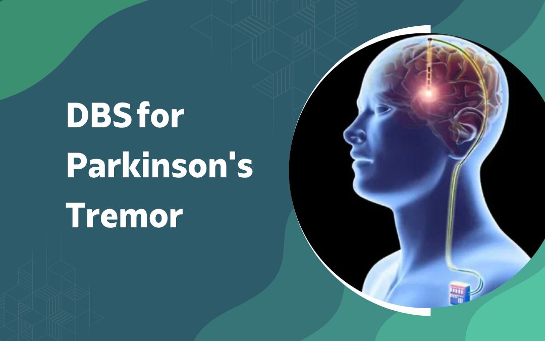 DBS for Parkinsons Tremor