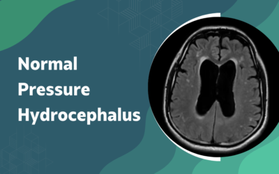 Is Normal Pressure Hydrocephalus Mistaken for Dementia?