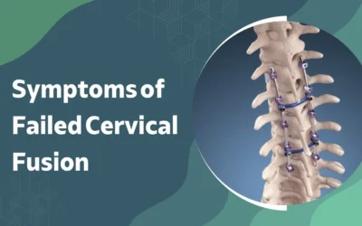 Symptoms of Failed Cervical Fusion