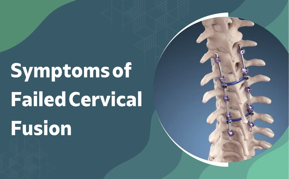 Symptoms of Failed Cervical Fusion