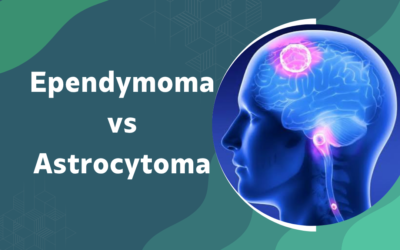 Ependymoma vs Astrocytoma: How Is Treatment Different?