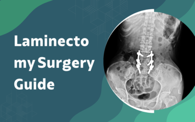 What Is Laminectomy and When Is It Needed?