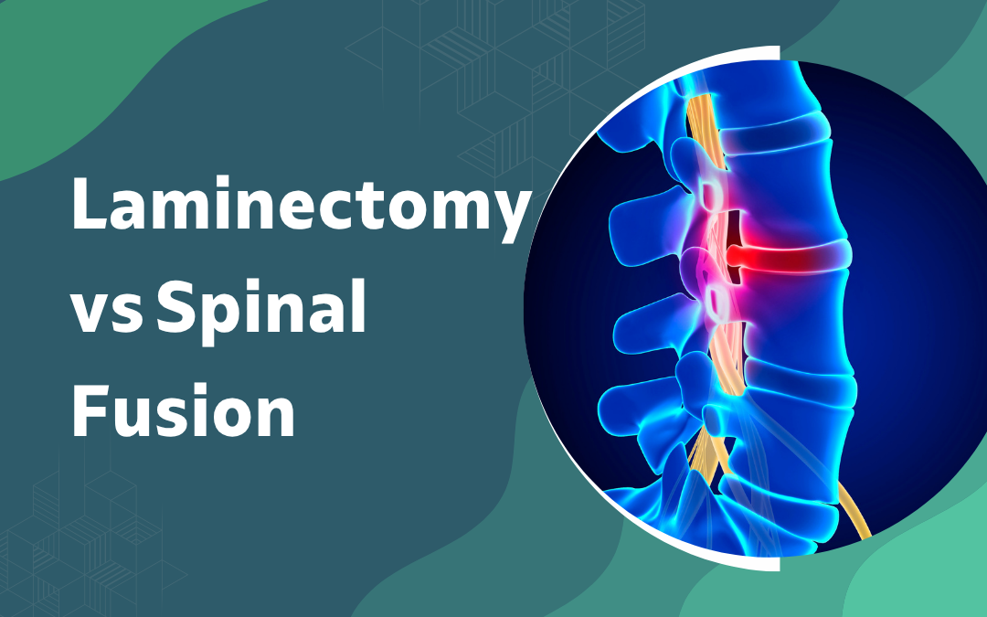 Laminectomy vs Spinal Fusion