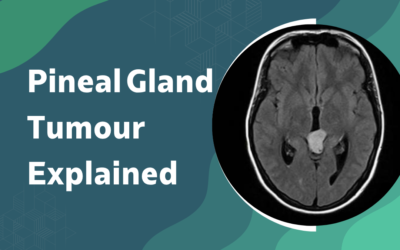 What Is Pineal Gland Tumour and How Is It Treated?