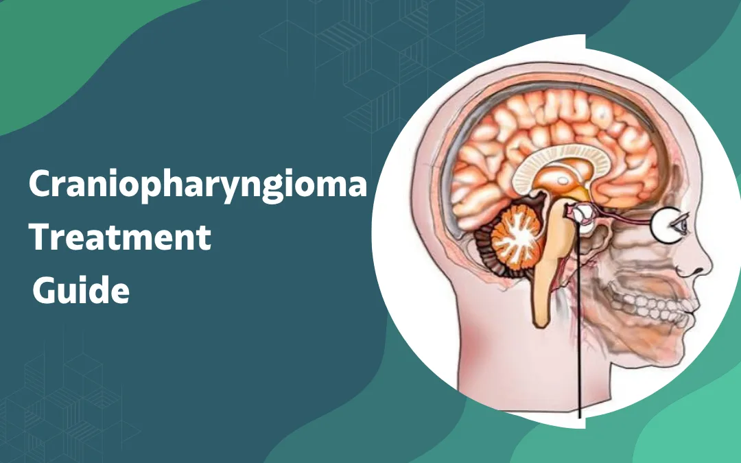 Craniopharyngioma Treatment Guide