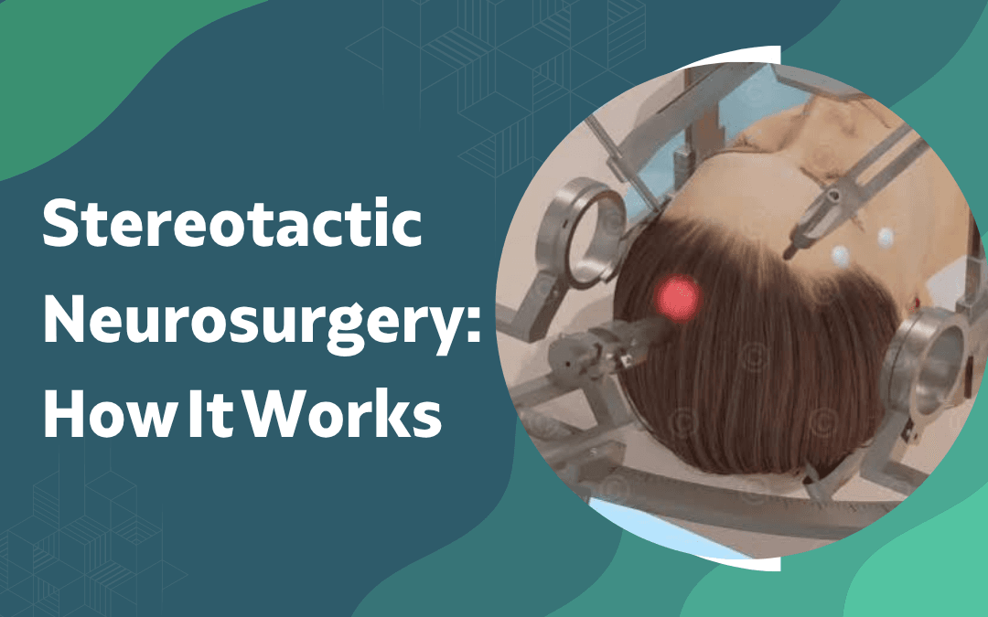 Stereotactic Neurosurgery How It Works